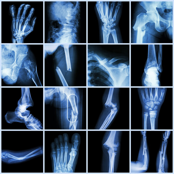 Рентген нескольких переломов костей (палец, позвоночник, запястье, бедро, нога, ключица, лодыжка, локоть, рука, нога
)