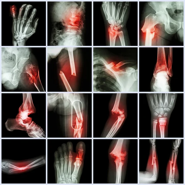 Collection X-ray multiple bone fracture (finger,spine,wrist,hip,leg,clavicle,ankle,elbow,arm,foot) — Stock Photo, Image