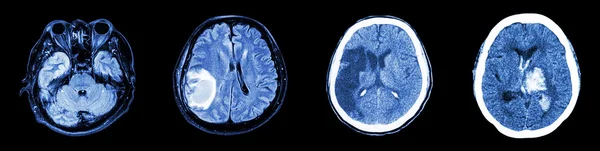 Collection CT scan du cerveau et des maladies multiples (de gauche à droite : cerveau normal, tumeur cérébrale, infarctus cérébral, hémorragie intracérébrale ) — Photo