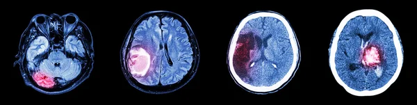 Recogida Tomografía computarizada de cerebro y enfermedad múltiple (izquierda a derecha: cerebro normal, tumor cerebral, infarto cerebral, hemorragia intracerebral ) —  Fotos de Stock