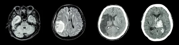 大脑和多种疾病的集合 Ct 扫描 (从左到右: 正常脑组织、 脑肿瘤、 脑梗塞、 脑出血) — 图库照片