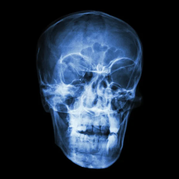 Asian people's skull (Thai people) — Stock Photo, Image