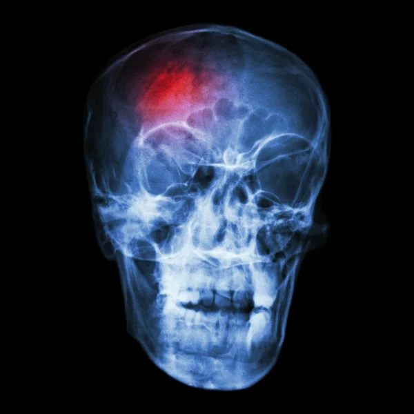 " Udar mózgu (incydent mózgowo-naczyniowy) "Strona X-ray azjatyckiej czaszki — Zdjęcie stockowe