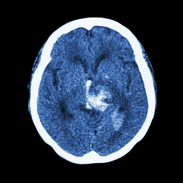 Tomografia computadorizada do cérebro: mostrar acidente vascular cerebral hemorrágico — Fotografia de Stock