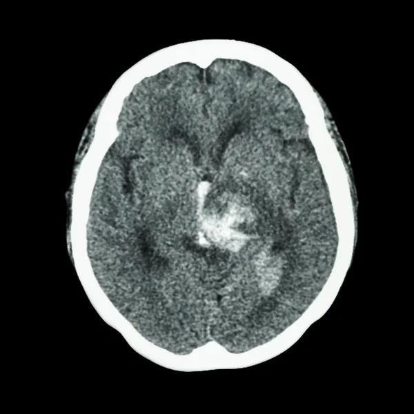Tomografía computarizada del cerebro: muestra accidente cerebrovascular hemorrágico —  Fotos de Stock