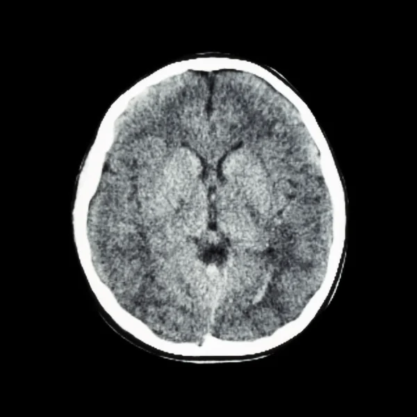 TC normal del cerebro (tomografía computarizada ) — Foto de Stock