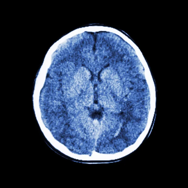 Normální Ct scan mozku (sloupecComputed tomografie) — Stock fotografie