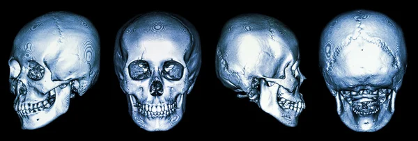 人类的头颅骨及三维 ct 扫描 — 图库照片