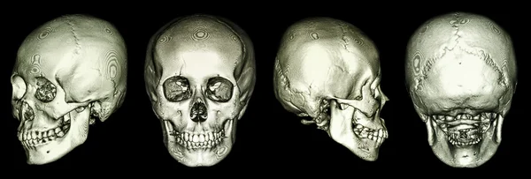 Ct Scan menschlicher Schädel und 3D — Stockfoto