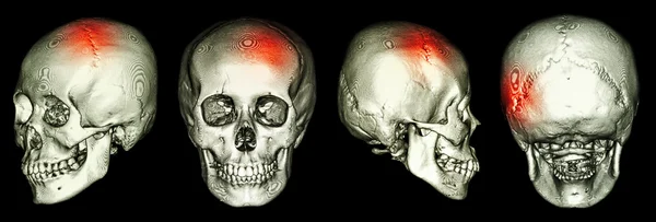 Ct Scan des menschlichen Schädels und 3D mit Schlaganfall (zerebrovaskulärer Unfall)) — Stockfoto