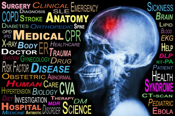 Cráneo de rayos X y "accidente cerebrovascular" y nube de palabras médicas —  Fotos de Stock
