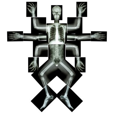 Canavar birçok kolu var. (X-ışını tüm vücut: baş boyun omuz kol ön kol dirsek bilek el basamak göğüs kaburga akciğer kalp omurga karın pelvik kalça uyluk bacak diz ayak bileği topuk ayak)