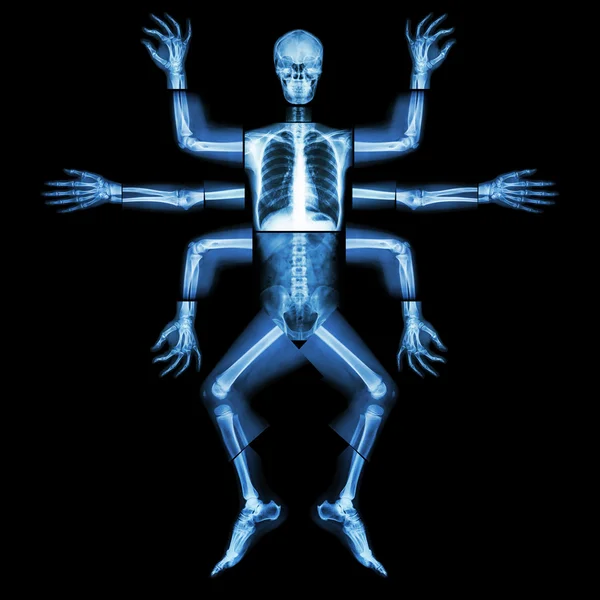 Monster have many arm. (X-ray whole body : head neck shoulder arm forearm elbow wrist hand digit thorax rib lung heart spine abdomen pelvic hip thigh leg knee ankle heel foot) — Stock Photo, Image