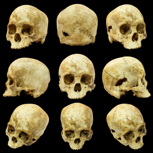 Raccolta di cranio umano (mongoloide) e cranio spezzato — Foto Stock