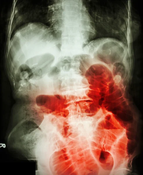 Obstrução intestinal. Filme X-ray abdominal supino: mostrar intestino delgado dilatado devido à obstrução do intestino delgado — Fotografia de Stock