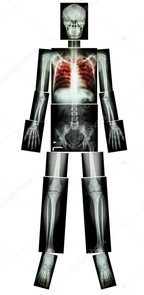 pulmonary tuberculosis tb x ray whole body head skull neck spine