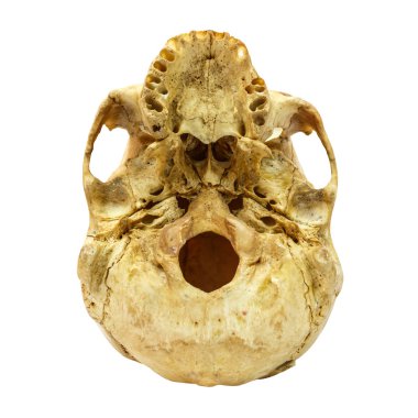 İnsan kafatası Fracture(beneath) (Mongol, Asya) izole arka