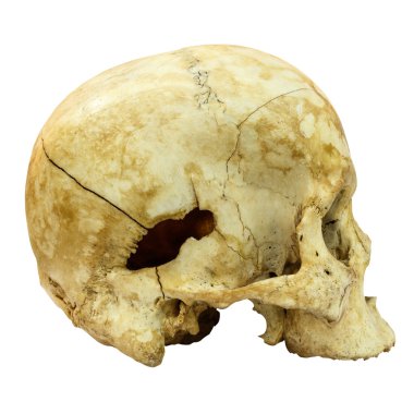 İnsan kafatası Fracture(side) (Mongol, Asya) izole backgro üzerinde