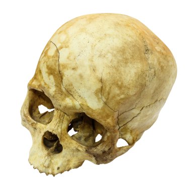 İnsan kafatası Fracture(top side,apex)(Mongoloid,Asian) on isolated