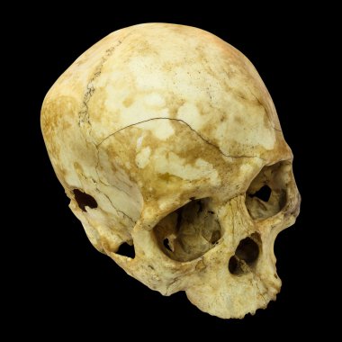 İnsan kafatası Fracture(top side,apex)(Mongoloid,Asian) on isolated
