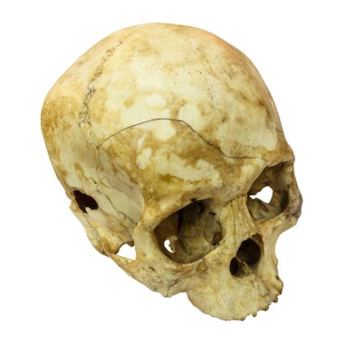 İnsan kafatası Fracture(top side,apex)(Mongoloid,Asian) on isolated