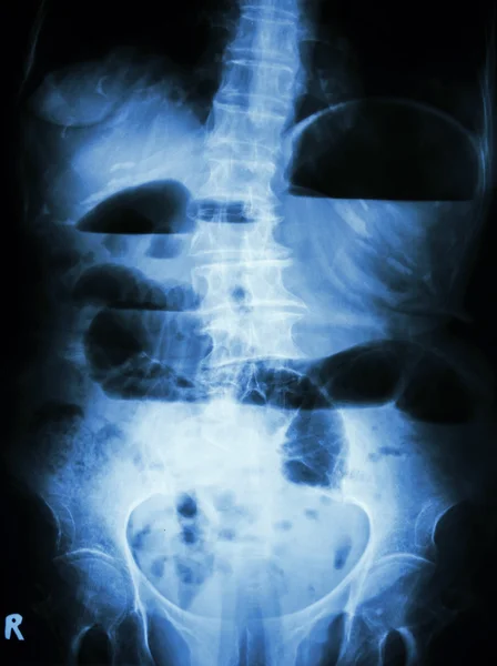 Kleine darmobstructie. Film X-ray buik rechtop: kleine darm uitgezet en lucht-vloeistof niveau in kleine darm te wijten aan kleine darmobstructie weergeven — Stockfoto