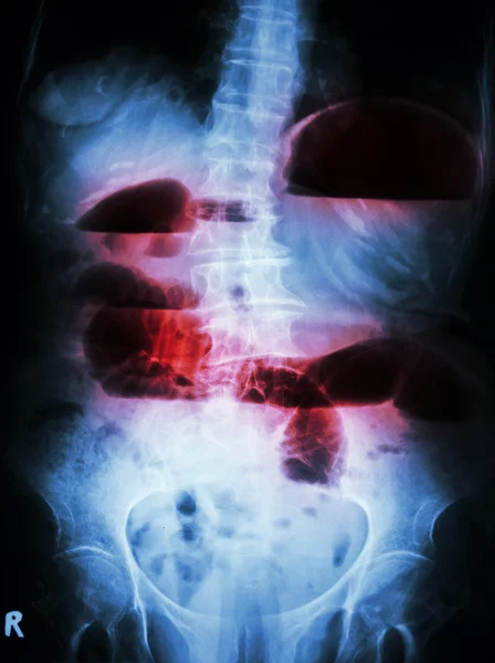 Small bowel obstruction — Stock Photo, Image