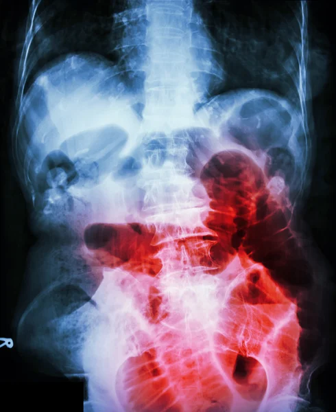 Obstrução intestinal. Filme X-ray abdominal supino: mostrar intestino delgado dilatado devido à obstrução do intestino delgado — Fotografia de Stock