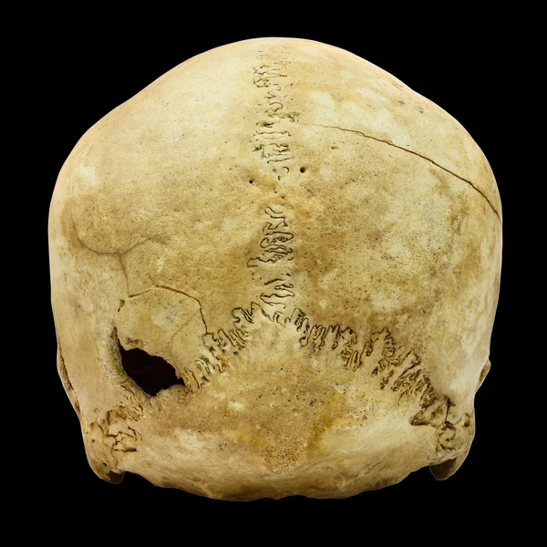 격리 된 b에 인간 두개골 골절 (뒷면) (저 능 아, 아시아) — 스톡 사진