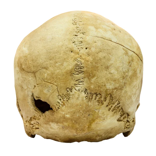 Human Skull Fracture (backside)  (Mongoloid,Asian) on isolated b — Stock Photo, Image