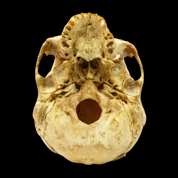 Frattura del cranio umano (sotto) (mongoloide, asiatico) sulla schiena isolata — Foto Stock