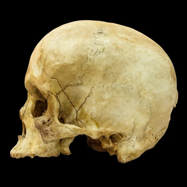 Human Skull Fracture (side)  (Mongoloid,Asian) on isolated background — Stock Photo, Image