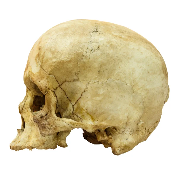 Human Skull Fracture (side)  (Mongoloid,Asian) on isolated background — Stock Photo, Image