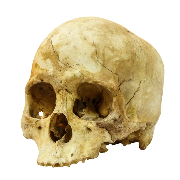 Fractura del cráneo humano (lado) (mongoloide, asiático) sobre fondo aislado —  Fotos de Stock