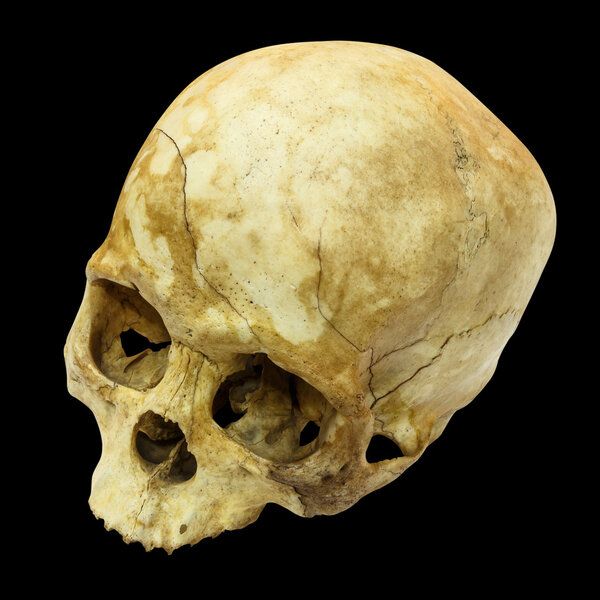 Human Skull Fracture(top side,apex)(Mongoloid,Asian) on isolated