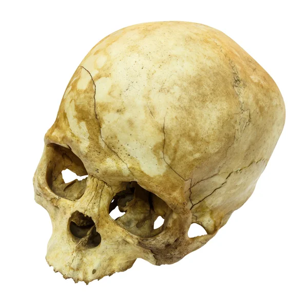 Human Skull Fracture(top side,apex)(Mongoloid,Asian) on isolated — Stock Photo, Image