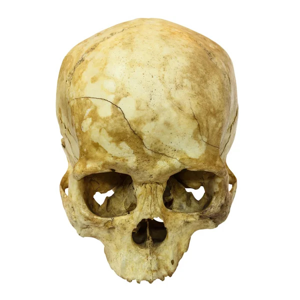Ανθρώπινο κρανίο Fracture(top side,apex)(Mongoloid,Asian) on isolated — Φωτογραφία Αρχείου