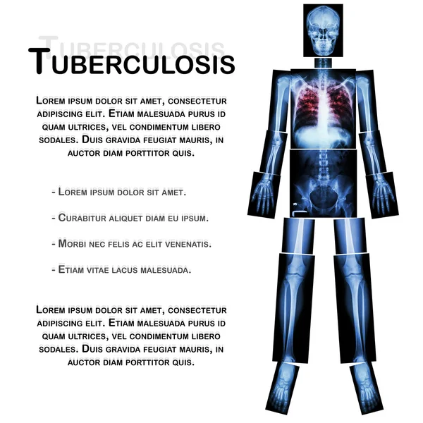 Pulmonary Tuberculosis (TB) (X-ray seluruh tubuh: tengkorak kepala tulang belakang lengan siku lengan lengan lengan lengan lengan lengan lengan dada thorax dada jantung paru-paru tulang rusuk belakang perut panggul pinggul lutut tumit kaki tumit kaki ) — Stok Foto