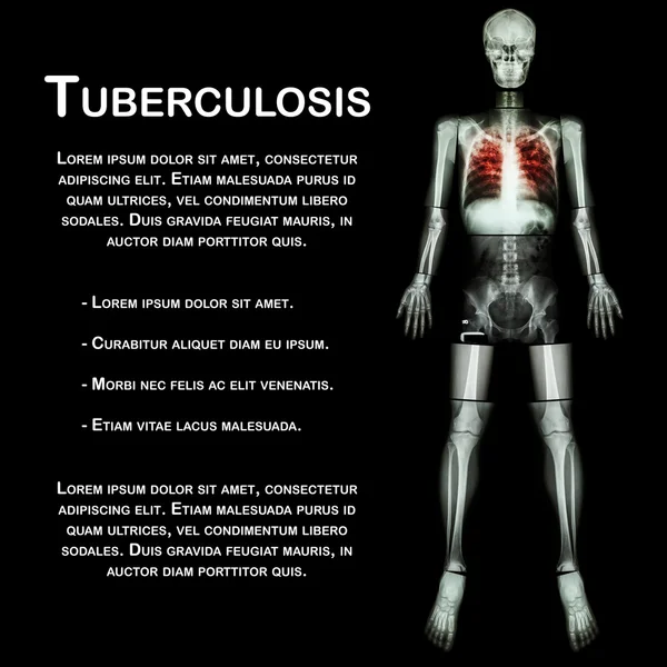 Pulmonális Tuberculosis(Tb) (egész test röntgen: fej, koponya nyak gerinc váll kar könyök alkar csukló kéz ujj mellkas mellkasi szív tüdő borda vissza has csípő csípő, comb térd láb boka láb sarok toe) — Stock Fotó