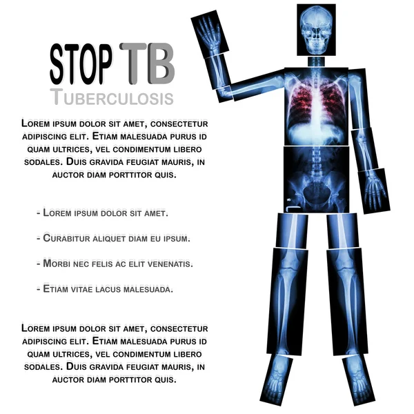 Stop TB (Tuberculosis) (Tangan angkat tulang manusia) (Seluruh tubuh: kepala tengkorak tulang belakang lengan bahu siku pergelangan tangan tangan toraks dada jantung tulang rusuk belakang perut panggul pinggul kaki pergelangan kaki ) — Stok Foto
