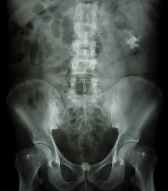 Left kidney stone(opaque area at right upper of image) and bladd clipart