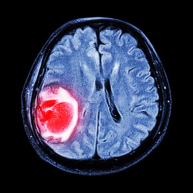 MRI beyin: beyin tümörü değil cerebrum, LOB parietal göster
