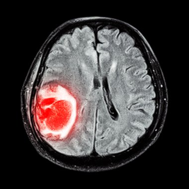 MRI beyin: beyin tümörü değil cerebrum, LOB parietal göster