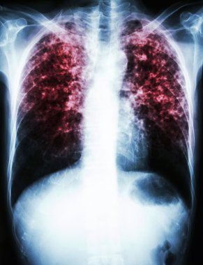Mycobacterium tüberküloz enfeksiyonu (akciğer tüberkülozu)