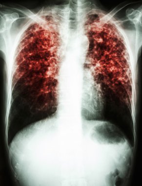 Mycobacterium tüberküloz enfeksiyonu (akciğer tüberkülozu)