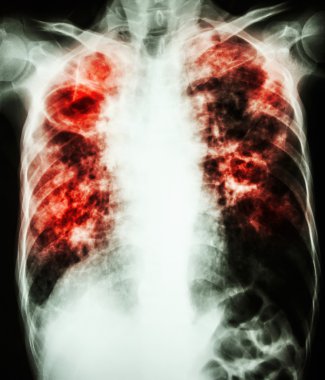 Mycobacterium tüberküloz enfeksiyonu (akciğer tüberkülozu)