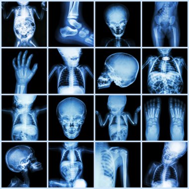 Koleksiyon X-ray çocuk vücut parçası (tüm vücut: kafatası baş boyun yüz omurga omuz göğüs Toraks akciğer kalp karın kol dirsek önkol kalça leğen kemiği kalça bacak ayak el bilek ayak bileği ortak bağırsak vb)