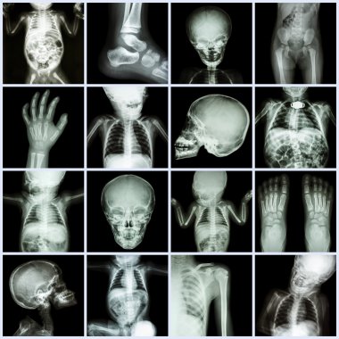 Koleksiyon X-ray çocuk vücut parçası (tüm vücut: kafatası baş boyun yüz omurga omuz göğüs Toraks akciğer kalp karın kol dirsek önkol kalça leğen kemiği kalça bacak ayak el bilek ayak bileği ortak bağırsak vb)