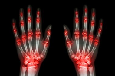 multiple joint arthritis both hands ( Gout , Rheumatoid ) on black background clipart