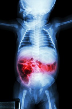 Enterit (X-ray hasta bebek ve bağırsak iltihabı)